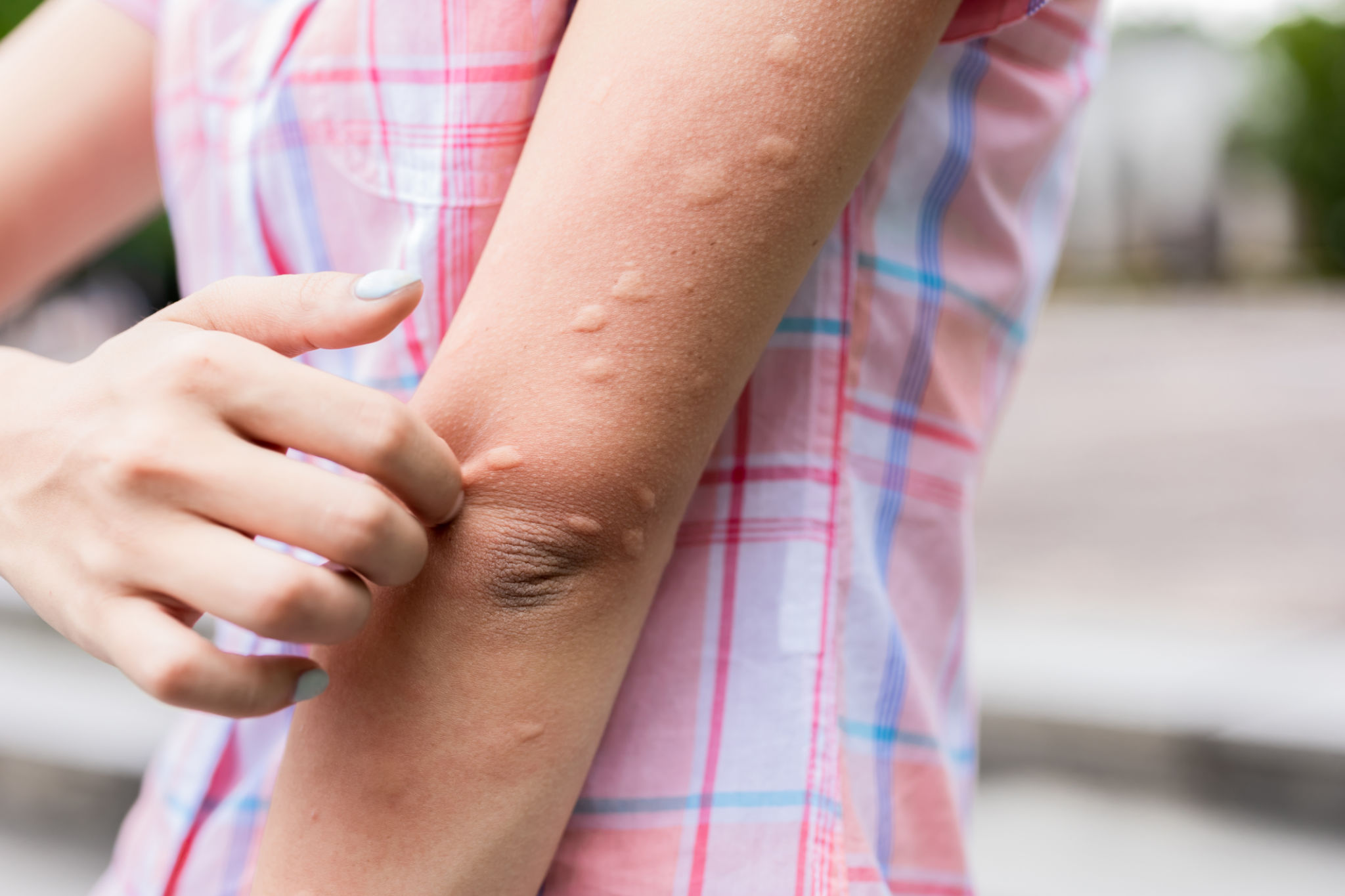 What Is Fungal Infection All You Need To Know About Treatment Of 