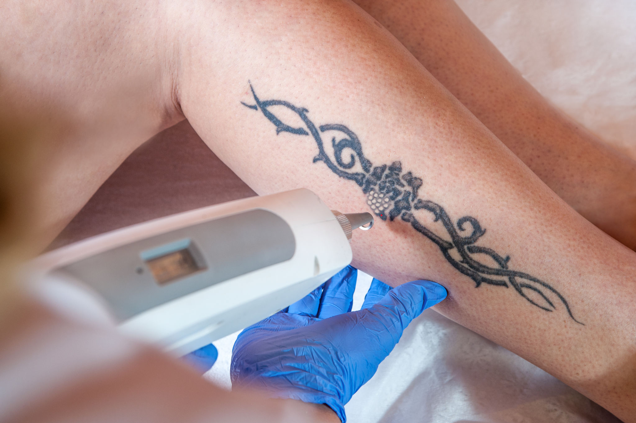How to remove tattoo permanently? - Cosmetic Dermatologist India